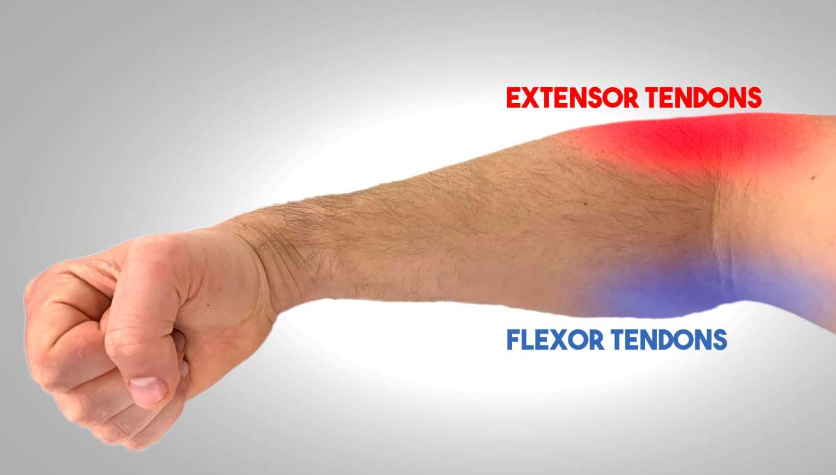 How Elbow Sleeves Can Help Your Tendonitis And Which Ones To Wear Strength Resurgence 6146