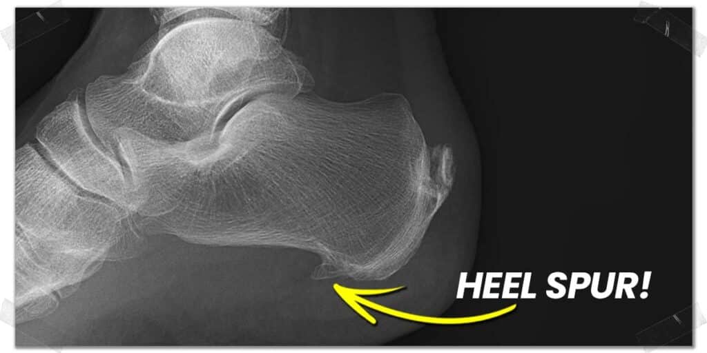 Causes Of Heel Pain When Squatting & Proven Solutions (Expert Tips ...